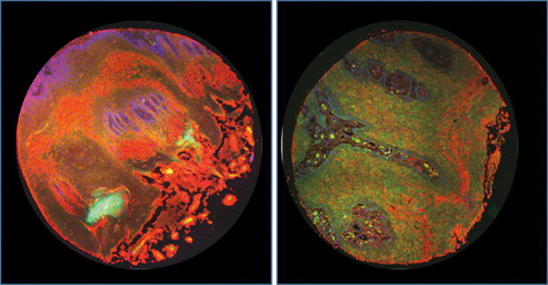 Side-by-side round images, one showing healthy tongue tissue stained red and the other cancerous tissue stained green.